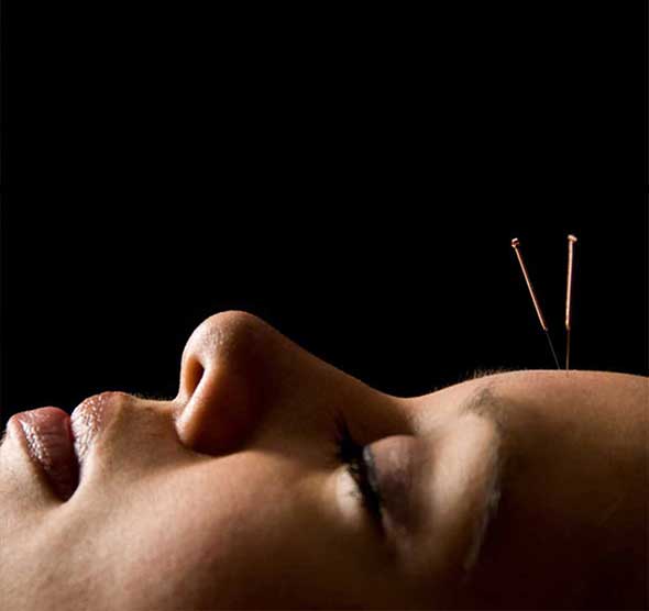 Acupuncture-For-Stress