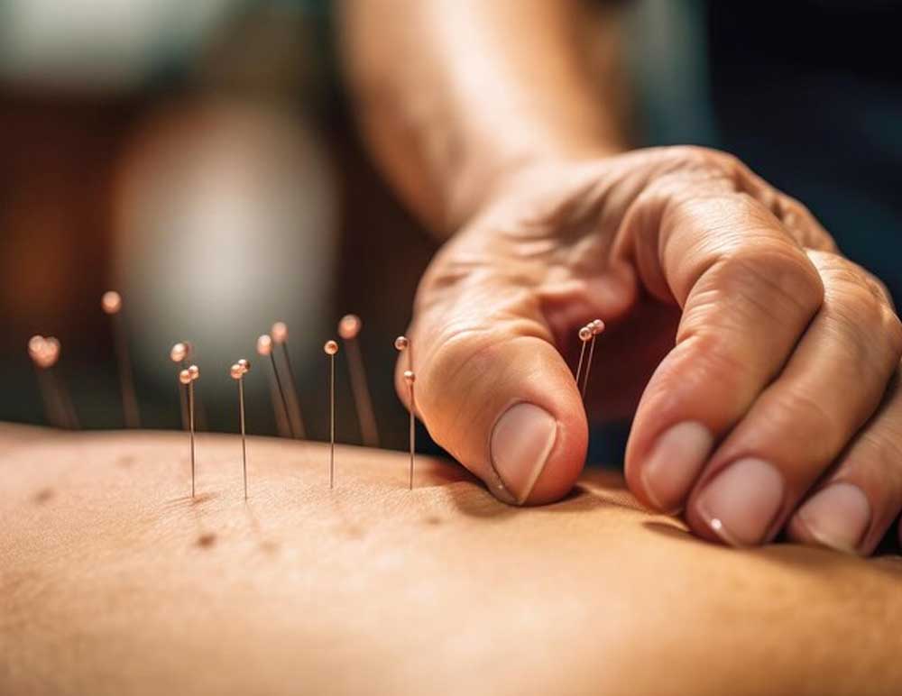 Acupuncture-for-Pain-Management