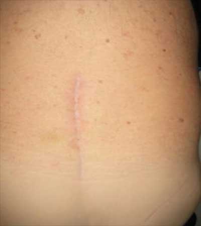 Scar-on-back-after-back-surgery-with-FBBS