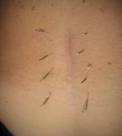Selection-of-acupuncture-points-for-FBSS